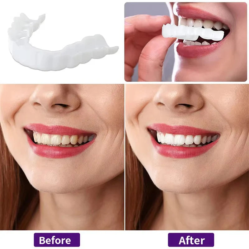 Teeth Whitening veneers (Perfect Smile)