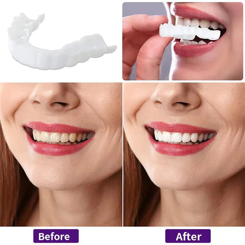 Teeth Whitening veneers (Perfect Smile)