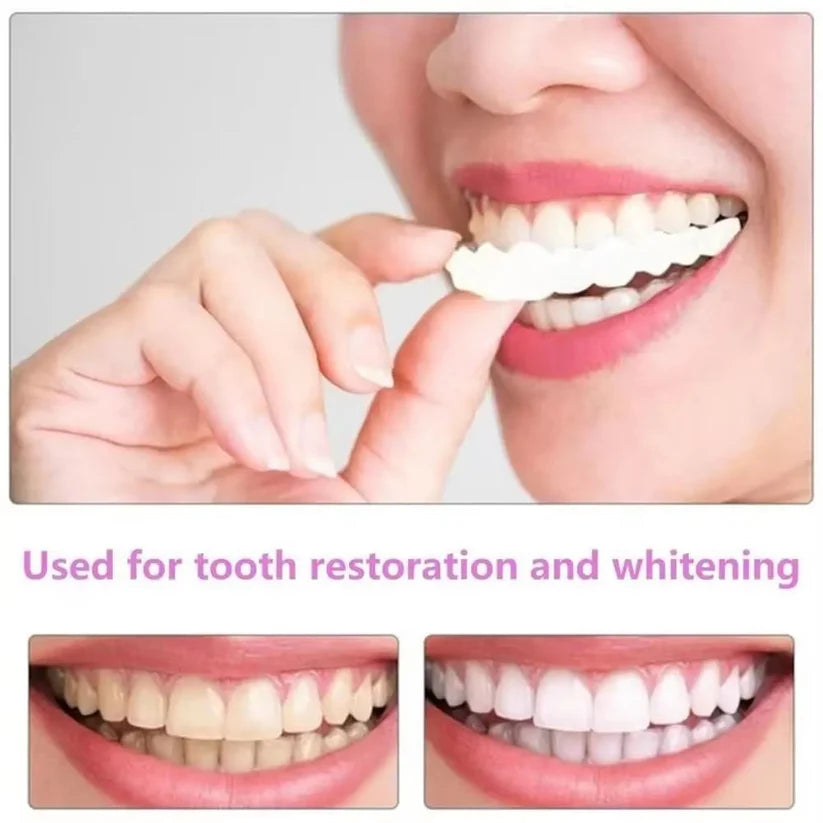 Teeth Whitening veneers (Perfect Smile)